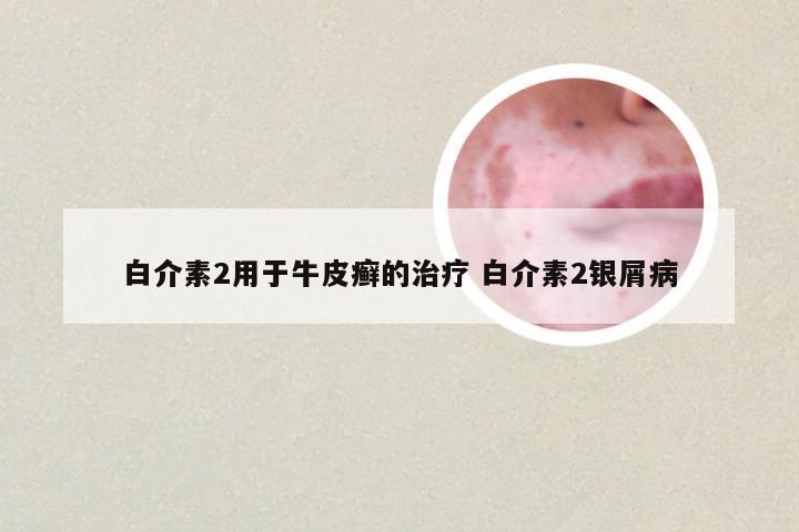 白介素2用于牛皮癣的治疗 白介素2银屑病