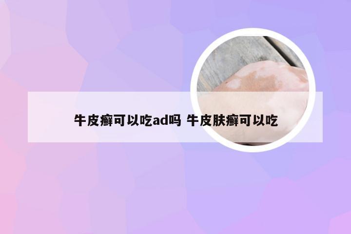 牛皮癣可以吃ad吗 牛皮肤癣可以吃