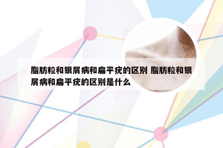 脂肪粒和银屑病和扁平疣的区别 脂肪粒和银屑病和扁平疣的区别是什么