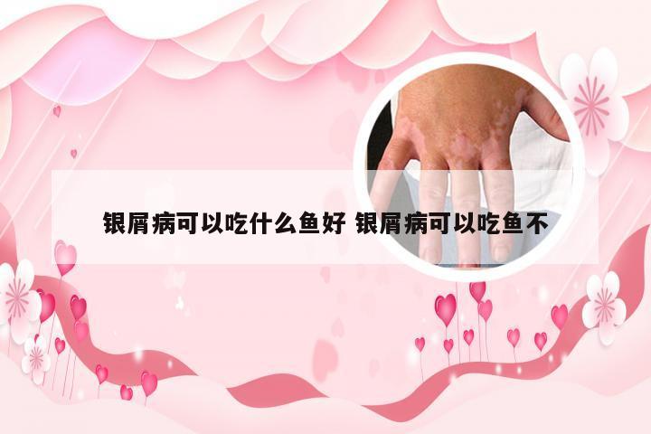 银屑病可以吃什么鱼好 银屑病可以吃鱼不