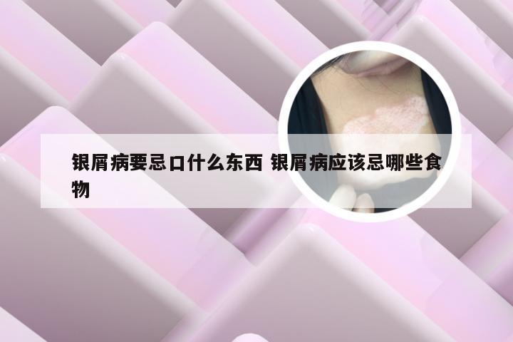 银屑病要忌口什么东西 银屑病应该忌哪些食物