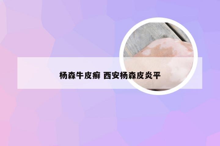 杨森牛皮癣 西安杨森皮炎平