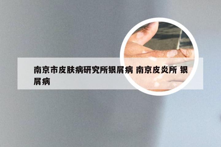南京市皮肤病研究所银屑病 南京皮炎所 银屑病