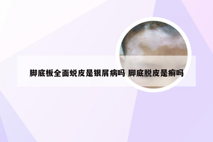 脚底板全面蜕皮是银屑病吗 脚底脱皮是癣吗