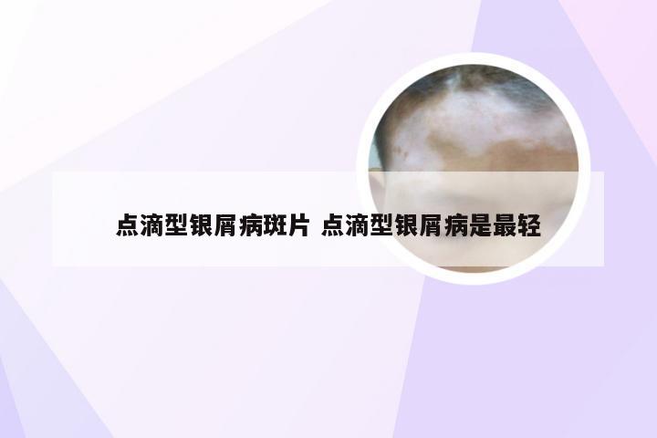 点滴型银屑病斑片 点滴型银屑病是最轻