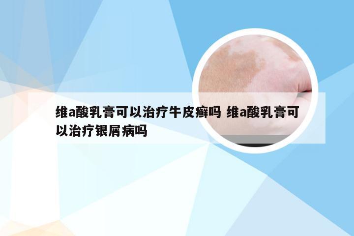 维a酸乳膏可以治疗牛皮癣吗 维a酸乳膏可以治疗银屑病吗