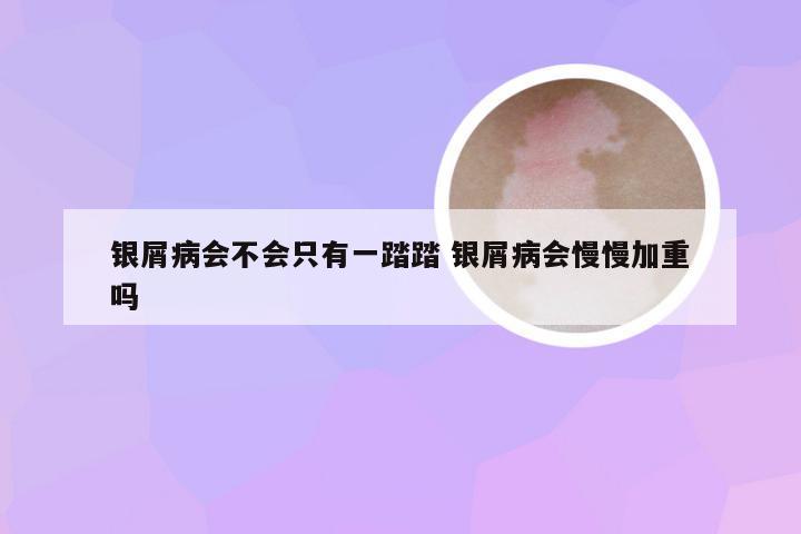 银屑病会不会只有一踏踏 银屑病会慢慢加重吗