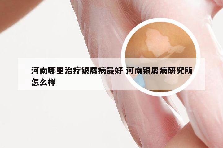 河南哪里治疗银屑病最好 河南银屑病研究所怎么样