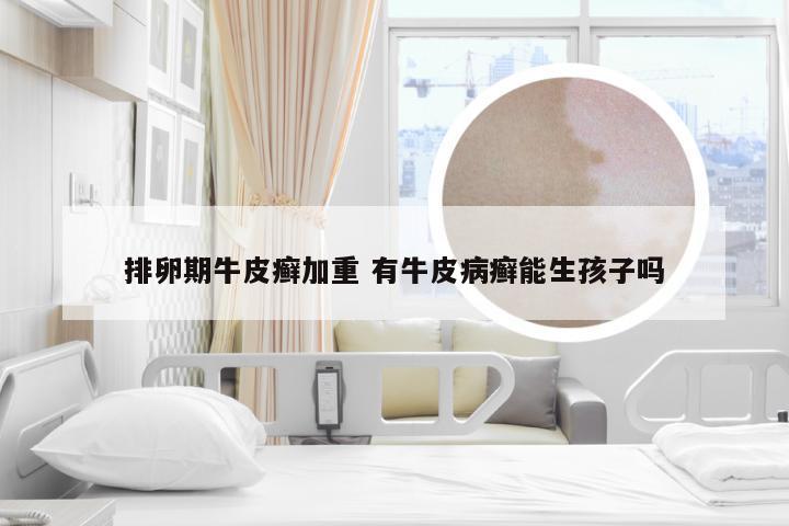 排卵期牛皮癣加重 有牛皮病癣能生孩子吗