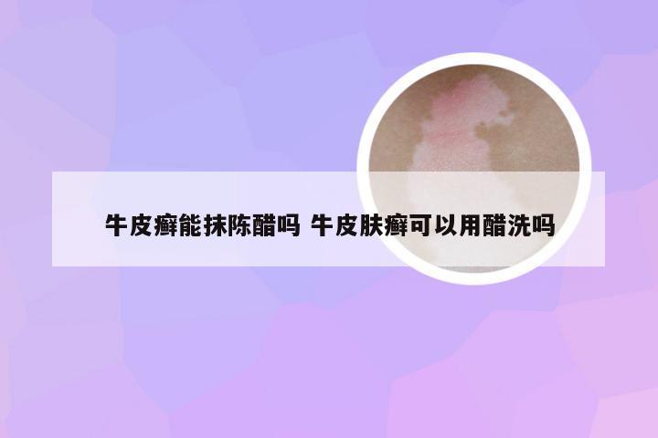 牛皮癣能抹陈醋吗 牛皮肤癣可以用醋洗吗