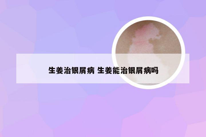 生姜治银屑病 生姜能治银屑病吗