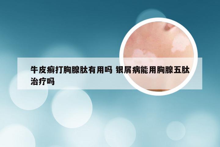 牛皮癣打胸腺肽有用吗 银屑病能用胸腺五肽治疗吗