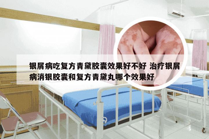 银屑病吃复方青黛胶囊效果好不好 治疗银屑病消银胶囊和复方青黛丸哪个效果好