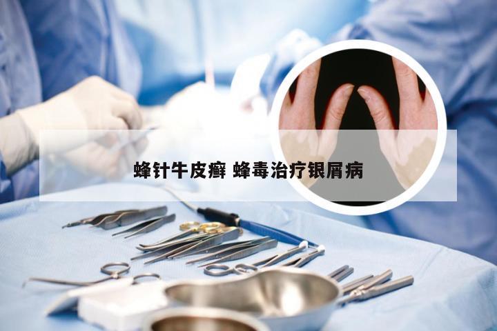 蜂针牛皮癣 蜂毒治疗银屑病