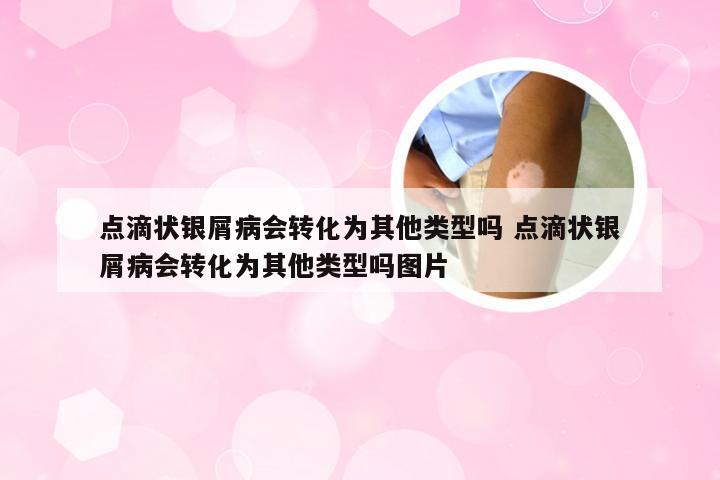 点滴状银屑病会转化为其他类型吗 点滴状银屑病会转化为其他类型吗图片