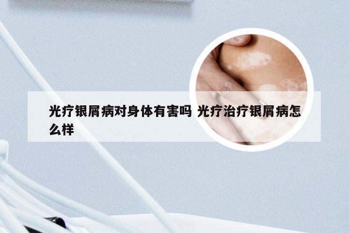 光疗银屑病对身体有害吗 光疗治疗银屑病怎么样