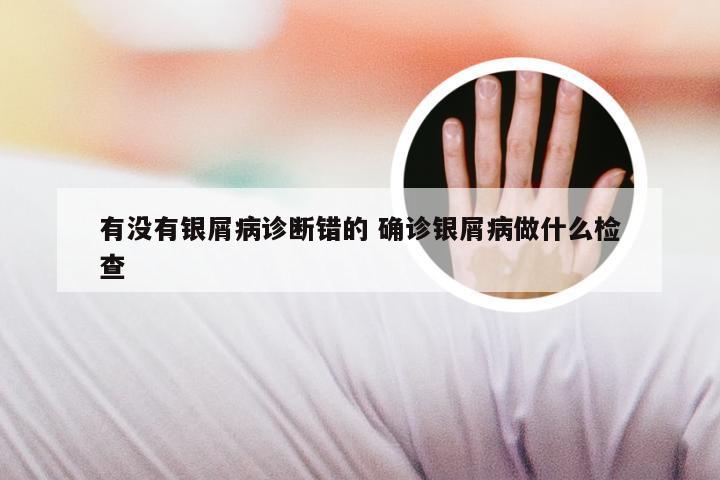 有没有银屑病诊断错的 确诊银屑病做什么检查