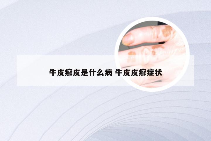 牛皮癣皮是什么病 牛皮皮癣症状
