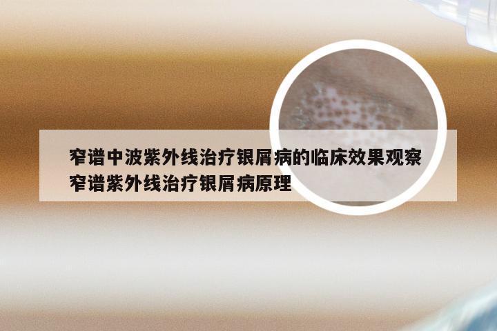 窄谱中波紫外线治疗银屑病的临床效果观察 窄谱紫外线治疗银屑病原理