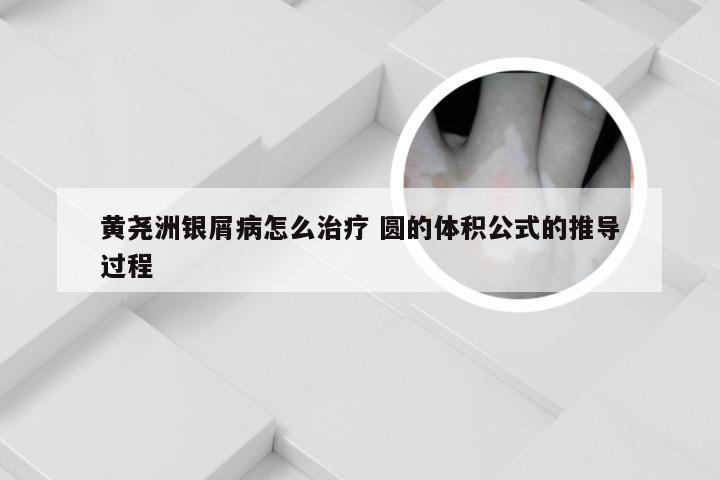 黄尧洲银屑病怎么治疗 圆的体积公式的推导过程