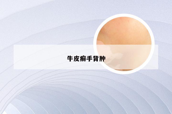 牛皮癣手背肿