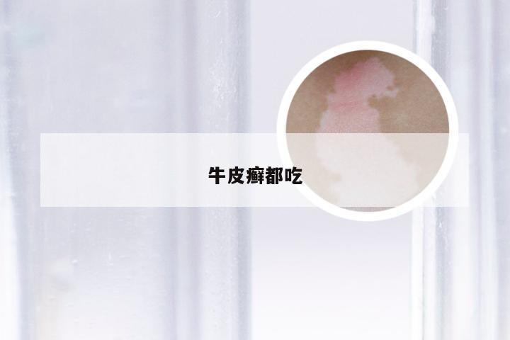 牛皮癣都吃