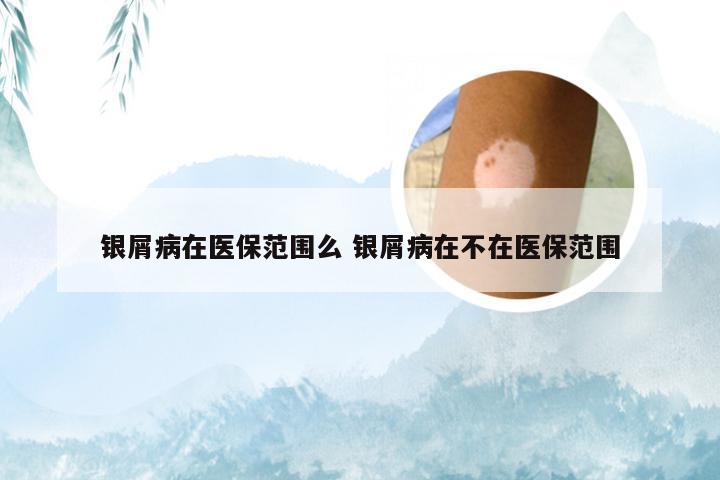 银屑病在医保范围么 银屑病在不在医保范围