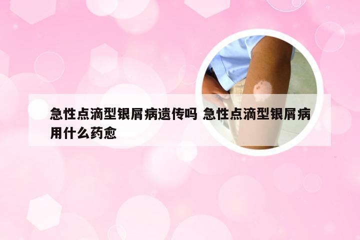 急性点滴型银屑病遗传吗 急性点滴型银屑病用什么药愈