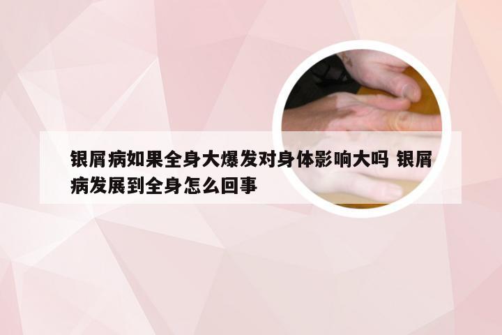银屑病如果全身大爆发对身体影响大吗 银屑病发展到全身怎么回事