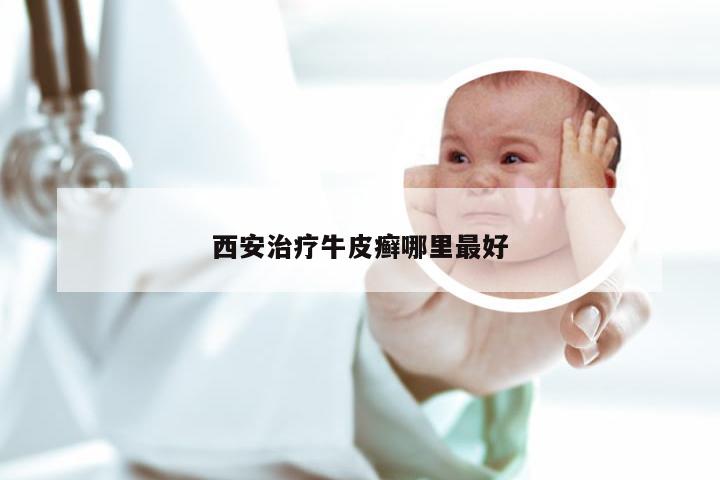 西安治疗牛皮癣哪里最好