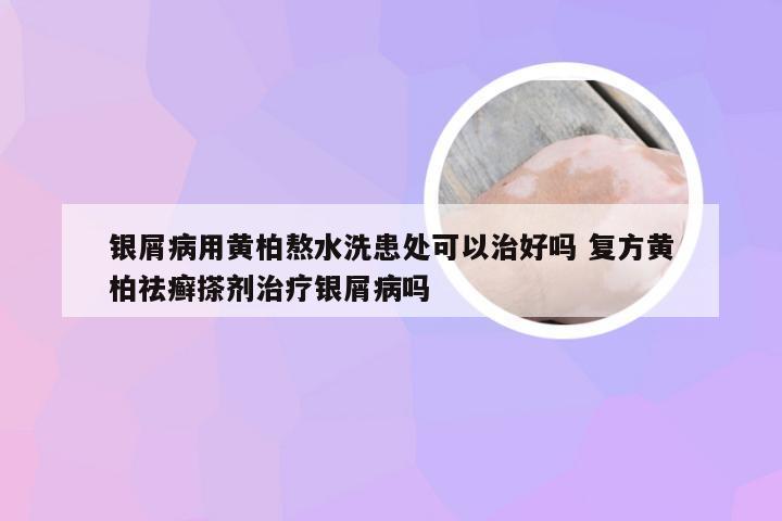 银屑病用黄柏熬水洗患处可以治好吗 复方黄柏祛癣搽剂治疗银屑病吗