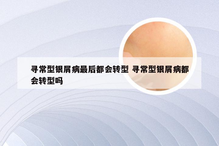 寻常型银屑病最后都会转型 寻常型银屑病都会转型吗