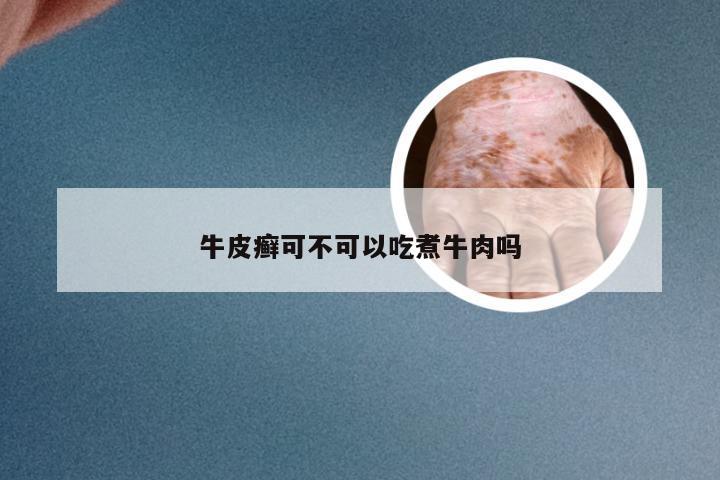 牛皮癣可不可以吃煮牛肉吗