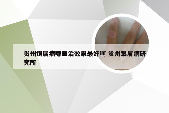 贵州银屑病哪里治效果最好啊 贵州银屑病研究所