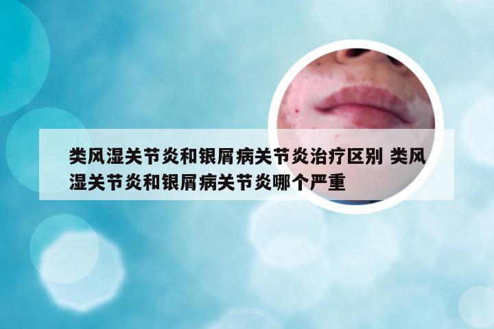 类风湿关节炎和银屑病关节炎治疗区别 类风湿关节炎和银屑病关节炎哪个严重