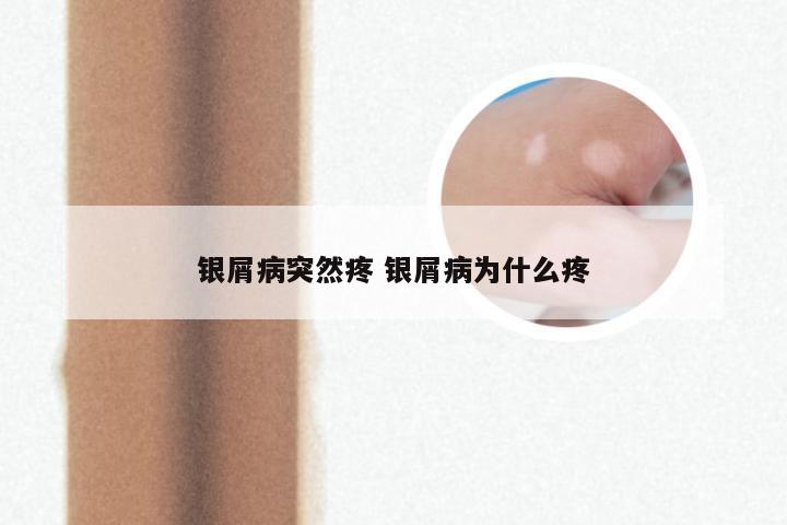 银屑病突然疼 银屑病为什么疼
