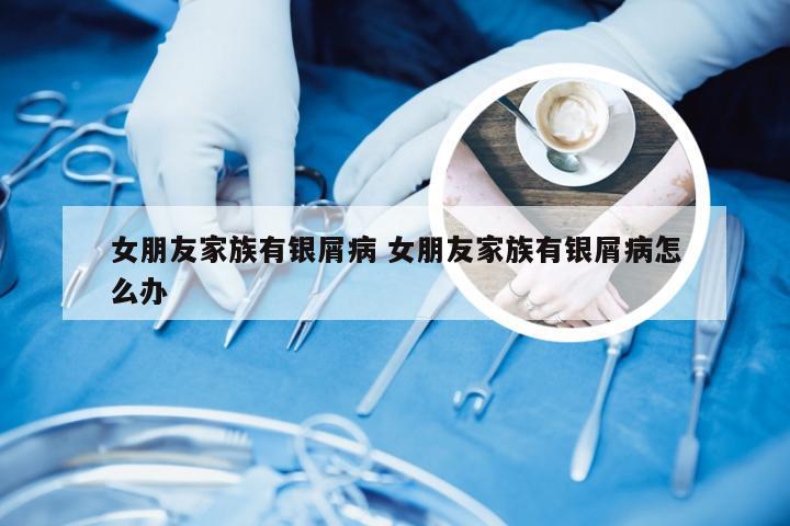 女朋友家族有银屑病 女朋友家族有银屑病怎么办