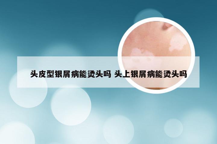 头皮型银屑病能烫头吗 头上银屑病能烫头吗