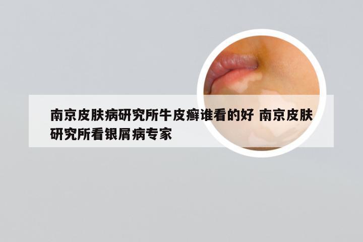 南京皮肤病研究所牛皮癣谁看的好 南京皮肤研究所看银屑病专家