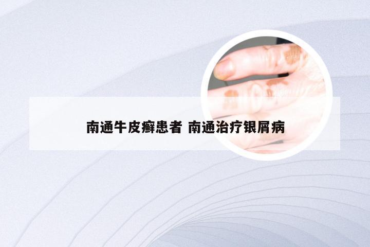 南通牛皮癣患者 南通治疗银屑病