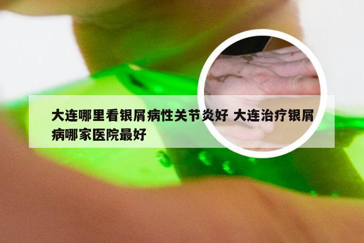 大连哪里看银屑病性关节炎好 大连治疗银屑病哪家医院最好