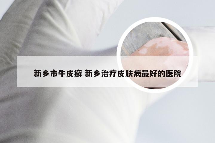 新乡市牛皮癣 新乡治疗皮肤病最好的医院