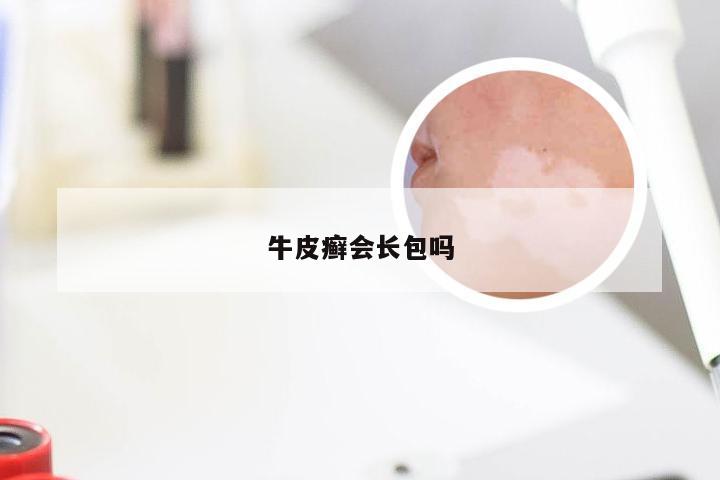 牛皮癣会长包吗