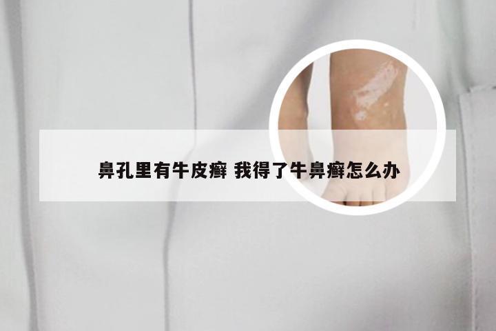 鼻孔里有牛皮癣 我得了牛鼻癣怎么办