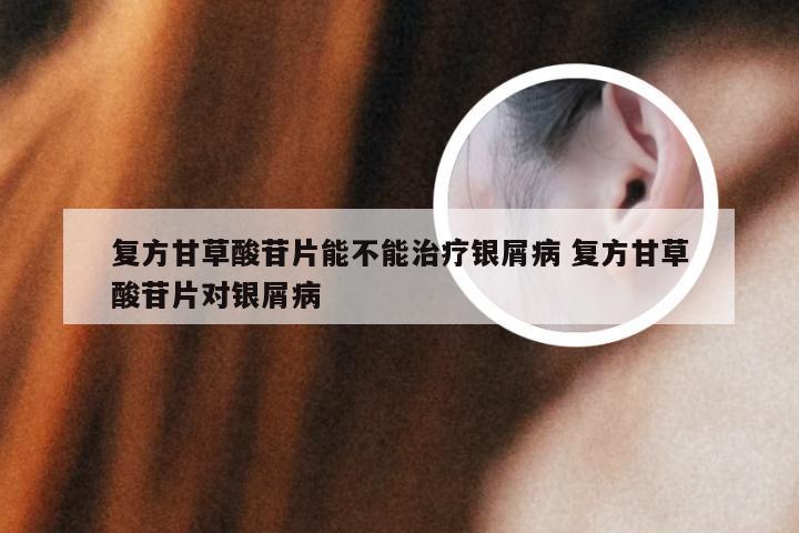 复方甘草酸苷片能不能治疗银屑病 复方甘草酸苷片对银屑病