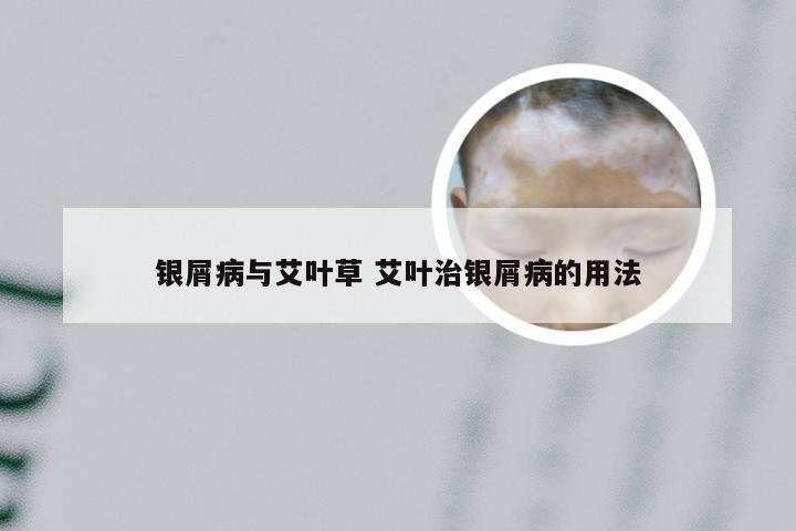 银屑病与艾叶草 艾叶治银屑病的用法