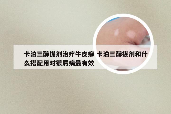 卡泊三醇搽剂治疗牛皮癣 卡泊三醇搽剂和什么搭配用对银屑病最有效