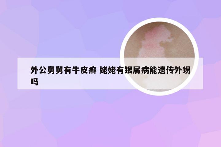 外公舅舅有牛皮癣 姥姥有银屑病能遗传外甥吗