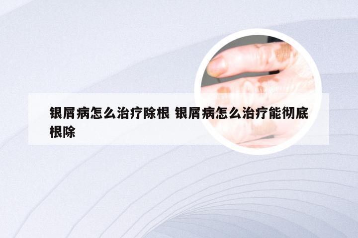 银屑病怎么治疗除根 银屑病怎么治疗能彻底根除