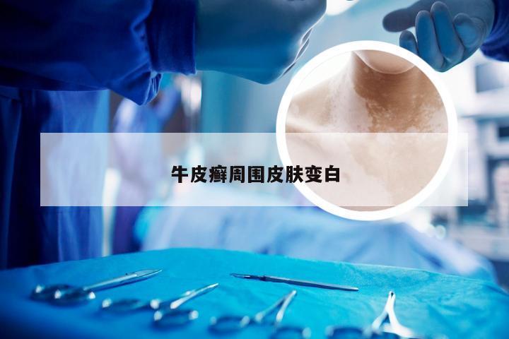 牛皮癣周围皮肤变白
